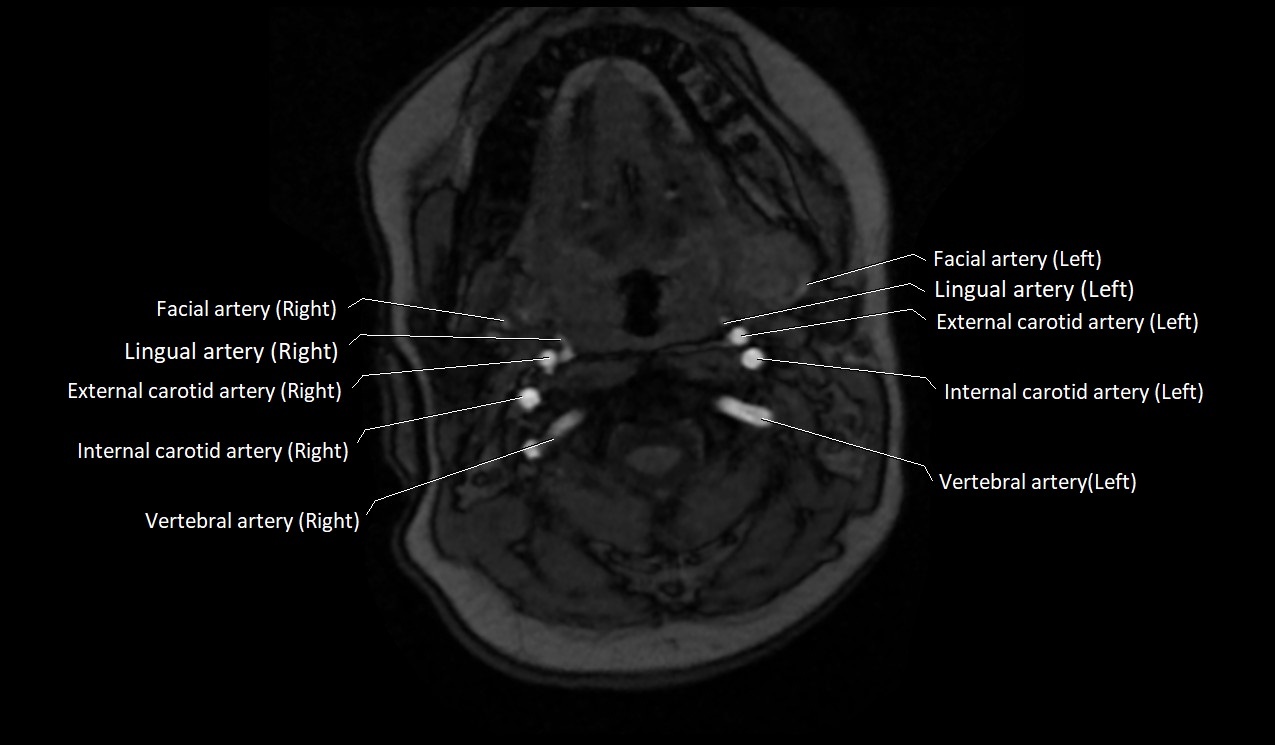 Carotid artery anatomy axial 3T image 20.jpg